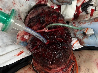 Soldier Loses both Hands and his Face due to Landmine Explosion