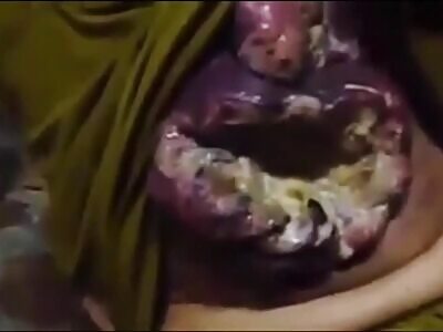 YIKES: Woman with infected breast