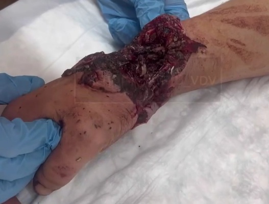 Russian wounded soldier with a horrific shattred hand 