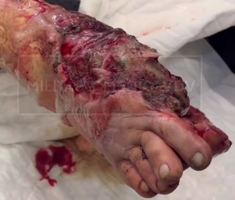 Russian soldier horrifically wounded due to landmine explosion 