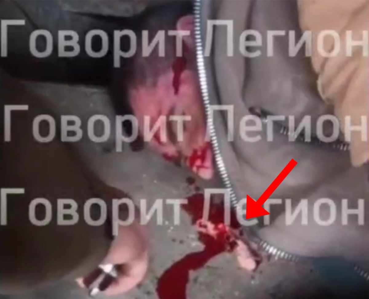 Ear removal surgery on a Ukrainian