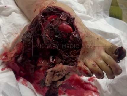 Russian soldier shattred leg after stepping on a landmine 