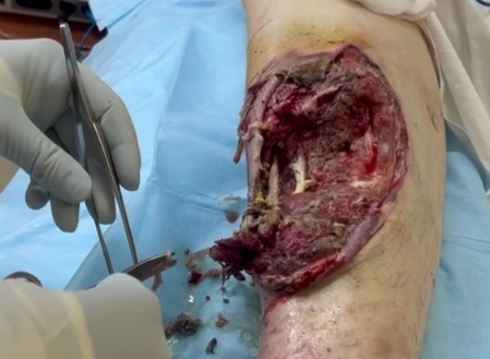 Russian wounded soldier with horrible hole in his leg hospitalized 