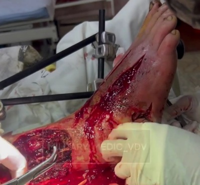 Wounded Russian soldier hospitalized 