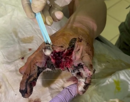 Wounded Russian soldier hospitalized 