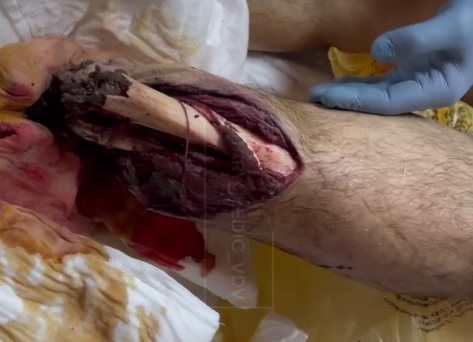 Russian soldier lost his leg after stepping on a landmine 