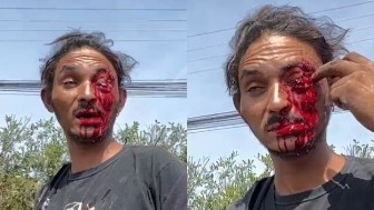 Homeless man lost his eye after being stabbed