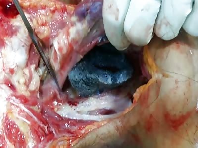 Cervical spine fracture fixation...autopsy study