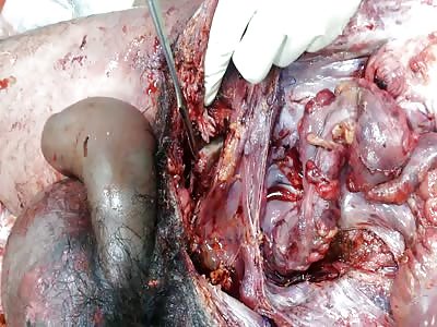 Postmortem study -pubic symphysis fracture 