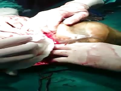 Rare case of full term abdominal pregnancy 