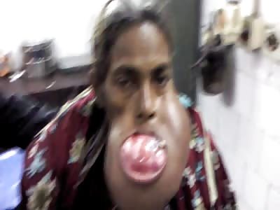 largest tumor of mandible | huge tumor