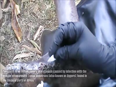 Trypophobia Feet and Jigger Removal