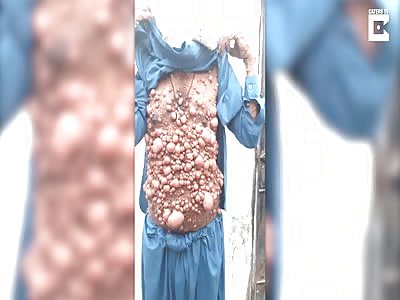 'Bubble Man' Forced To Live As Recluse