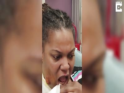 Huge Abscess Erupts Like Volcano On Face