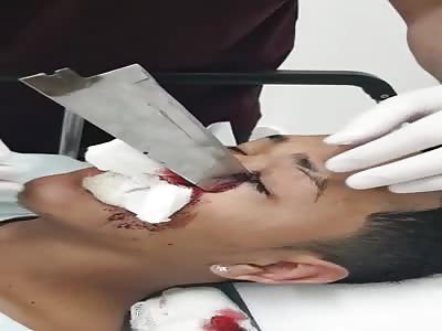 Man with knife stuck in the face