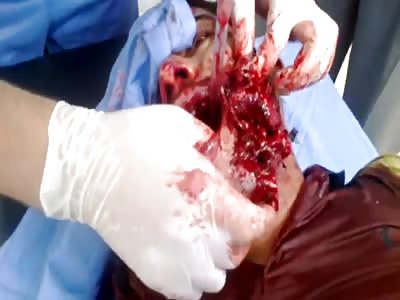 Civilian wounded with shrapnel stuck in mouth