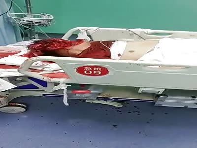 Man Still Alive with his Face Unrecognizable Completely Ripped after Chainsaw Accident 