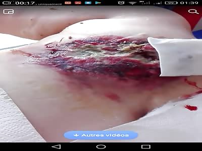 Tunisian woman suffer from Breast cancer