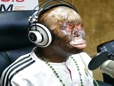 VICTIM OF ELECTROCUTION CRIES WHILE TALKING ABOUT HIS LIFE