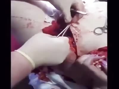 Homemade Abdominoplasty