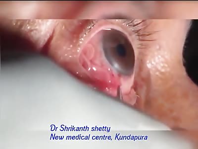 People get eye worms, too.