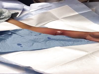 arm infected after cut knife