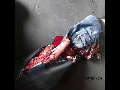 (with aftermath pics)LOSING LEG IN INDUSTRIAL ACCIDENT