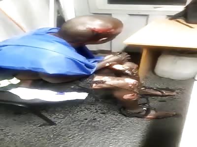 burned man in emergency