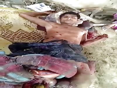 Lookin at What's Left of his Foots