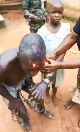 Man After Self-Immolation (Skin Hanging) 