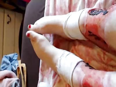 Self harm gone bad,very bad