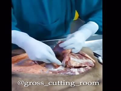 Autopsy of young man dead after heart attack 