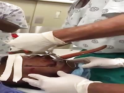 Knife removal with locking pliers/mole grips.