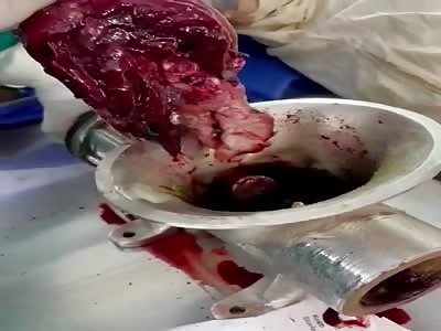 Hand destroyed by meats grinder 