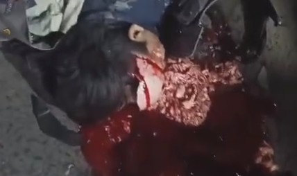 Brain Spilling Moped Accident