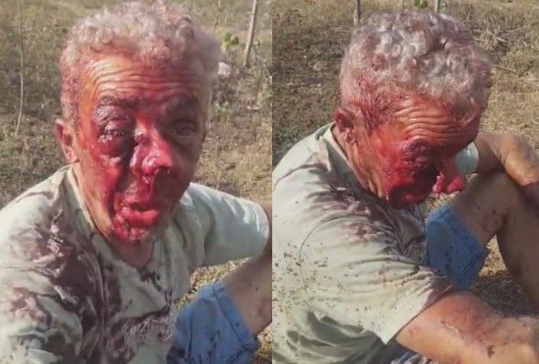 Man`s Nose Almost Ripped Off After A Motorcycle Accident