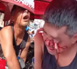 Tuk Tuk Driver Lost Eye on Mirror Screw in Accident