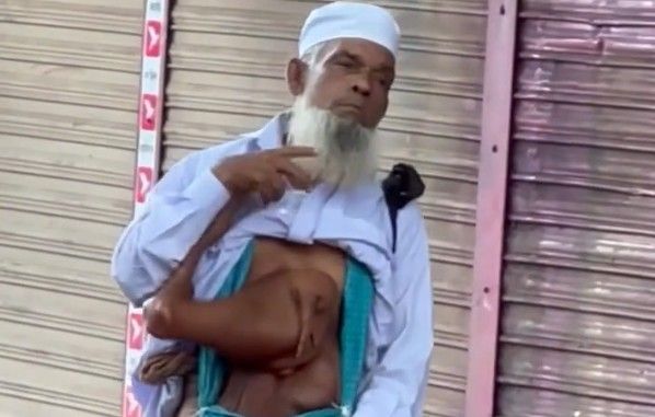 Indian man grows a chicken leg on his chest