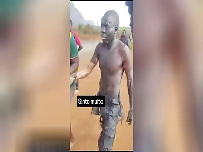  MAN WITH SEVERE BURNS