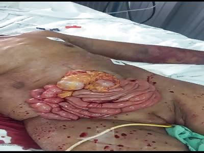 Woman bleeds her intestines out