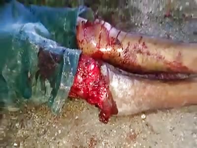 ACCIDENT leave the leg shattered