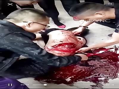 IMPACTANT CUT CAUSED BY FIGHT AND MACHETE