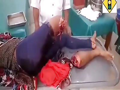 ACCIDENT LEAVES THE WOMAN WITHOUT LEG