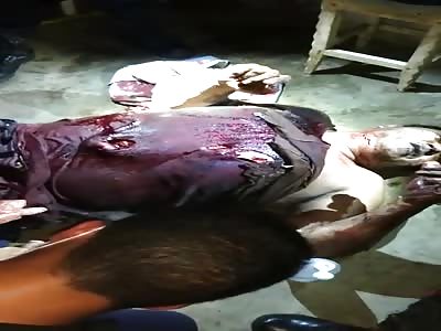 MAN WITH BURNS IN THE BODY