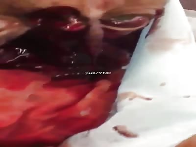  Vietnamese Man's Face Completely Destroyed 