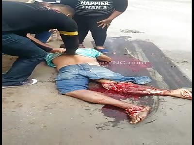 BRUTAL ACCIDENT LEAVES MAN WITH LEGS DESTROYED