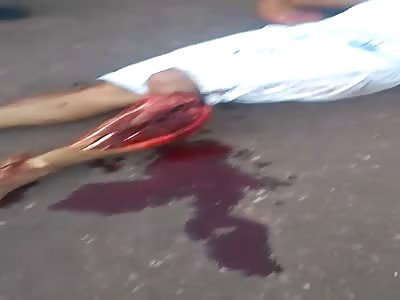 BRUTAL ACCIDENT LEAVES MAN WITH LEGS DESTROYED