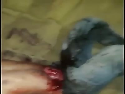 Stabbing  Leaves Young Guy with Guts Hanging Out Abdomen in Brazil