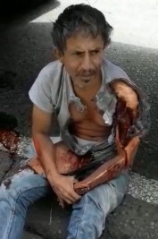 Man's Arm is Skinned to the Bone and has Fingers Missing