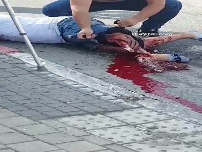 Brutal accident, man with broken legs